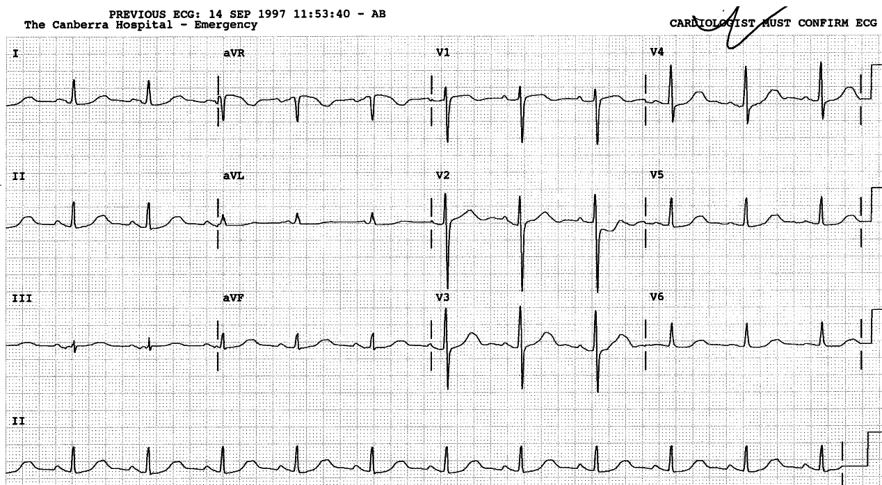 LAA: terminal P negativity in lead 3 makes up for invisible PTF in V1. The T waves look distorted, but nothing measures up.