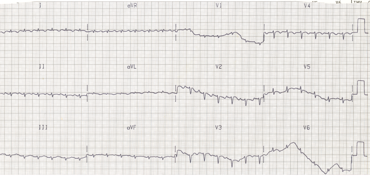 Pericardial deposits and effusion