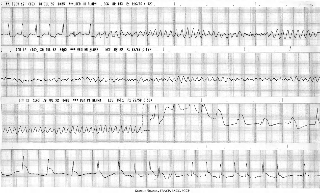 70 year old man following cardiac arrest at home. Admission ECG showed acute inferior MI. 