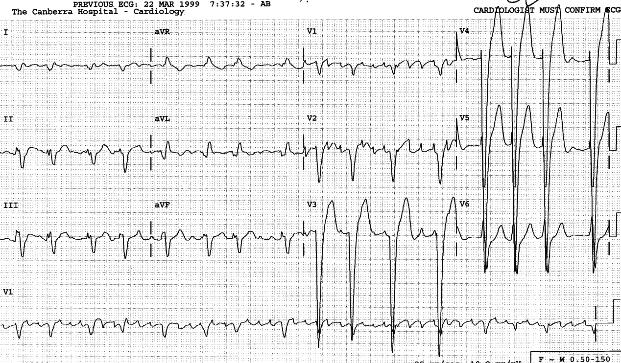 60 year old man with severe global LV dysfunction and cardiomegaly.