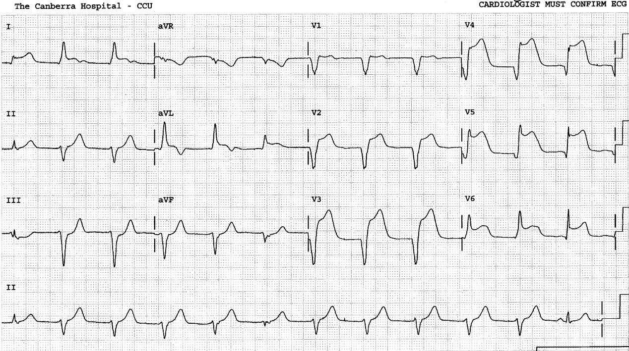 76 year old man with paroxysms of dyspnÅa and weakness.