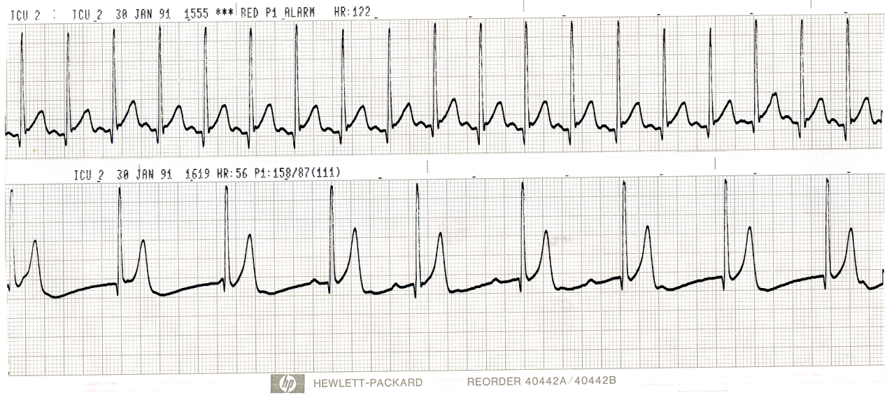 P1 in the top strip alarming the monitor was 55 mmHg systolic.