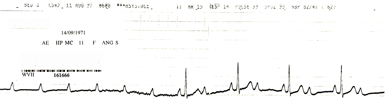 Transition from high-grade to 2:1 AVB. 