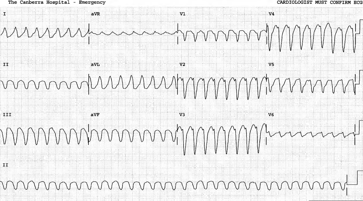 69 year old man with history of myocardial infarction 20 years previously, collapsed during a walk. He was confused in Casualty, with blood pressure 75 mmHg systolic. There was no response to IV amiodarone. He was cardioverted with biphasic 150 Joule shock. 