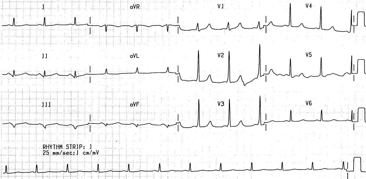 76 year old man with chest tightness persisting for 2 hours.