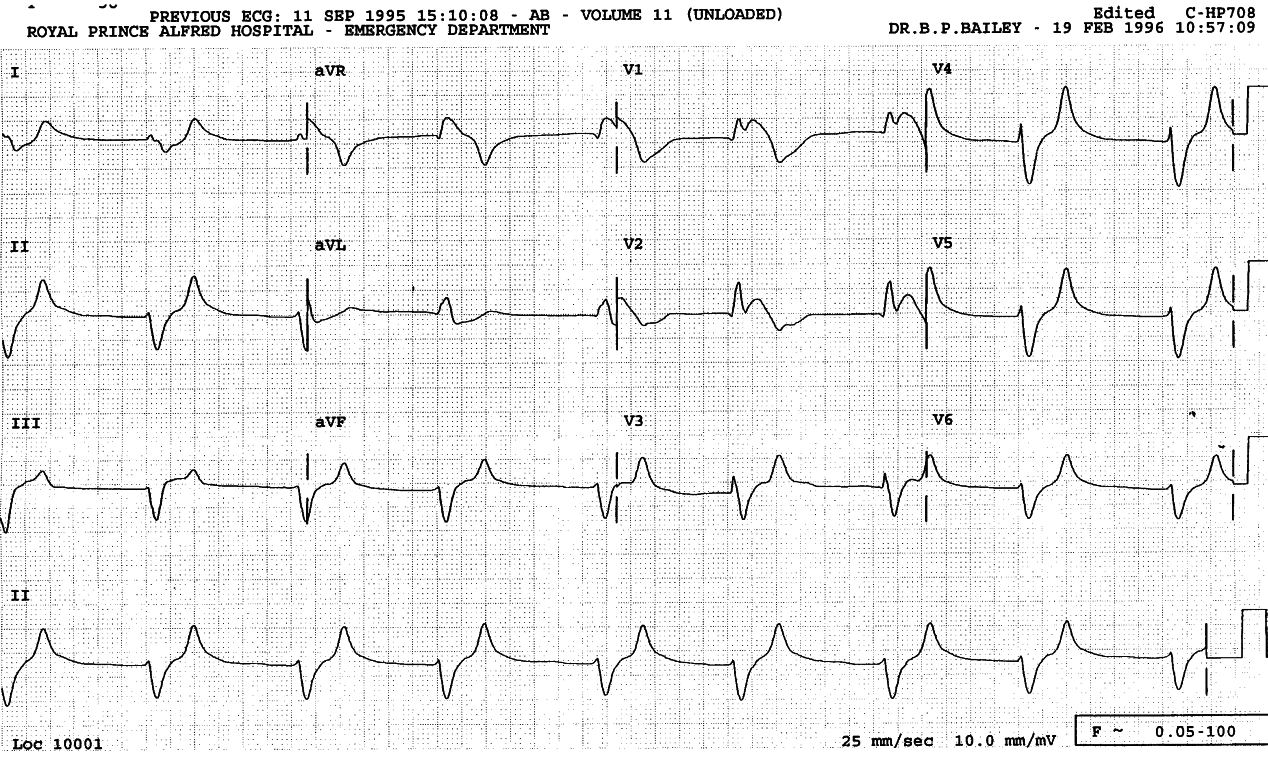 72 year old man with recent exacerbation of chronic renal failure