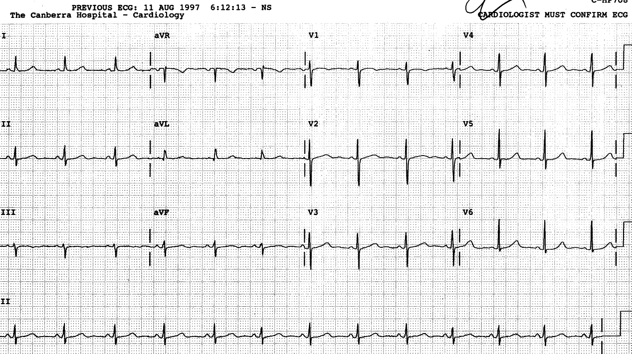 Normal ECG.  