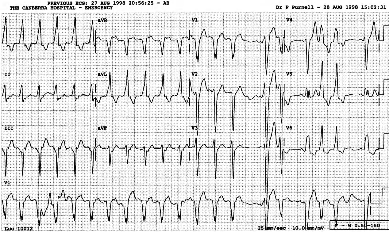 Hypotensive episode in a 77 year old man ventilated in ICU for fibrosing alveolitis from which he died several days later. 