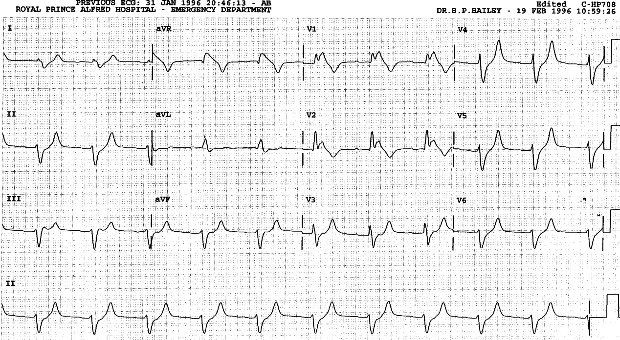 Emerging P waves