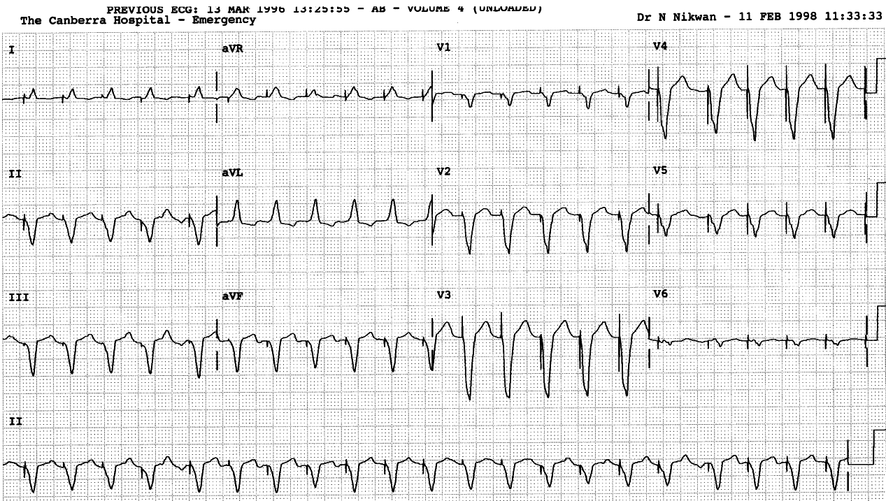 73 year old man with permanent pacemaker and slightly
irregular tachycardia.