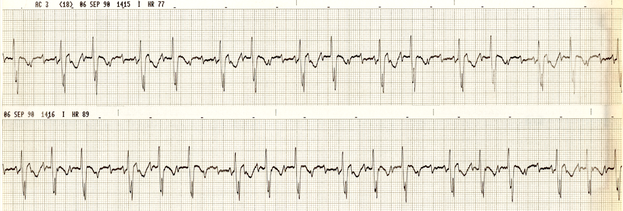 The patient was a 75 year old woman awaiting     cardioversion on quinidine. What classical mechanism informs her     bigeminy no less than her trigeminy? 