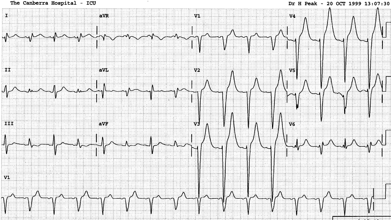 59 year old following Bentall procedure for aortic dissection.