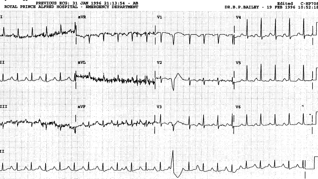 Prominent P waves