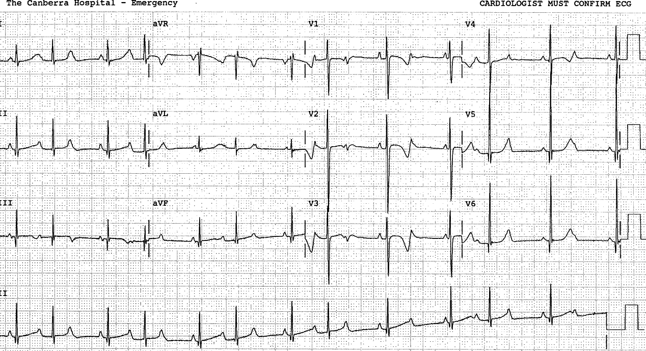 Same patient, in escape-capture bigeminy. 