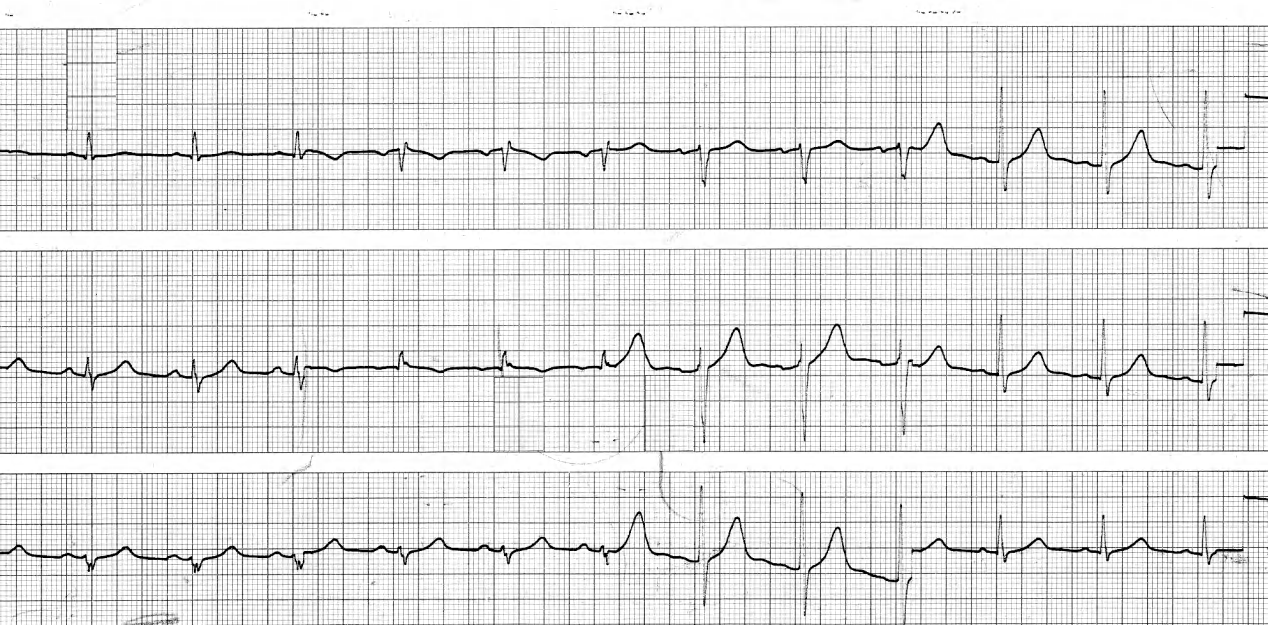 T3 > T1 in sinus rhythm. This would be normal in a âvertical heartâ, but this heart is âhorizontal;â (aVL and aVF diverge). 