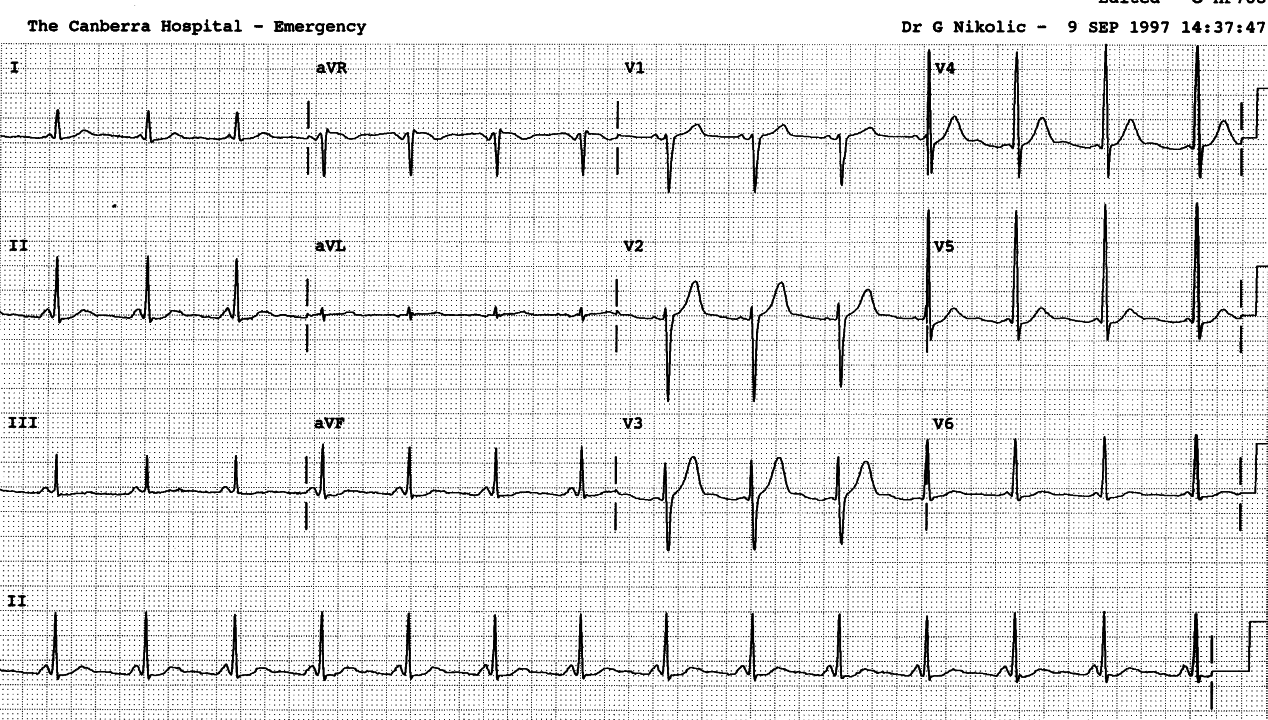 41 year old man with chest pain.