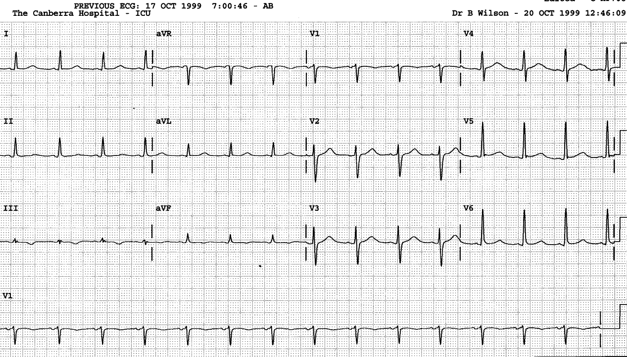 Two days later the ECG normalised.