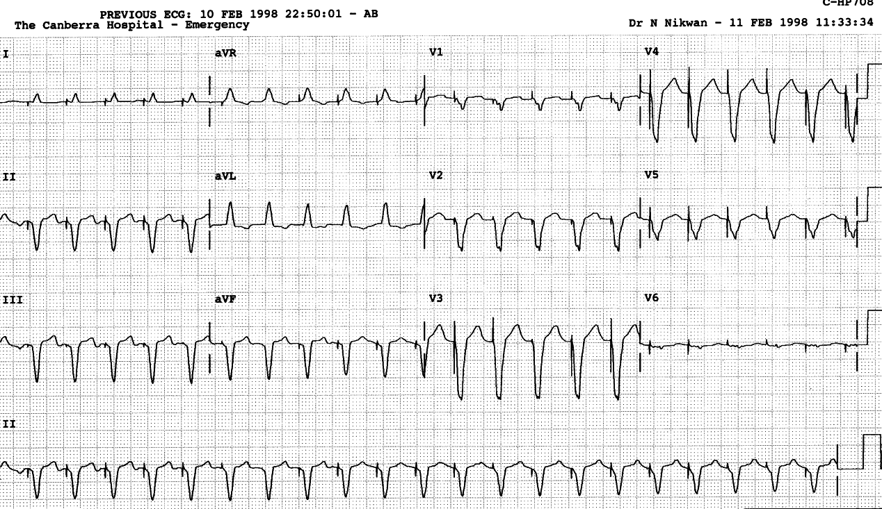 Regular broad-complex pacemaker tachycardia resulting from
sensing atrial flutter. The unit was eventually changed to VVI mode.