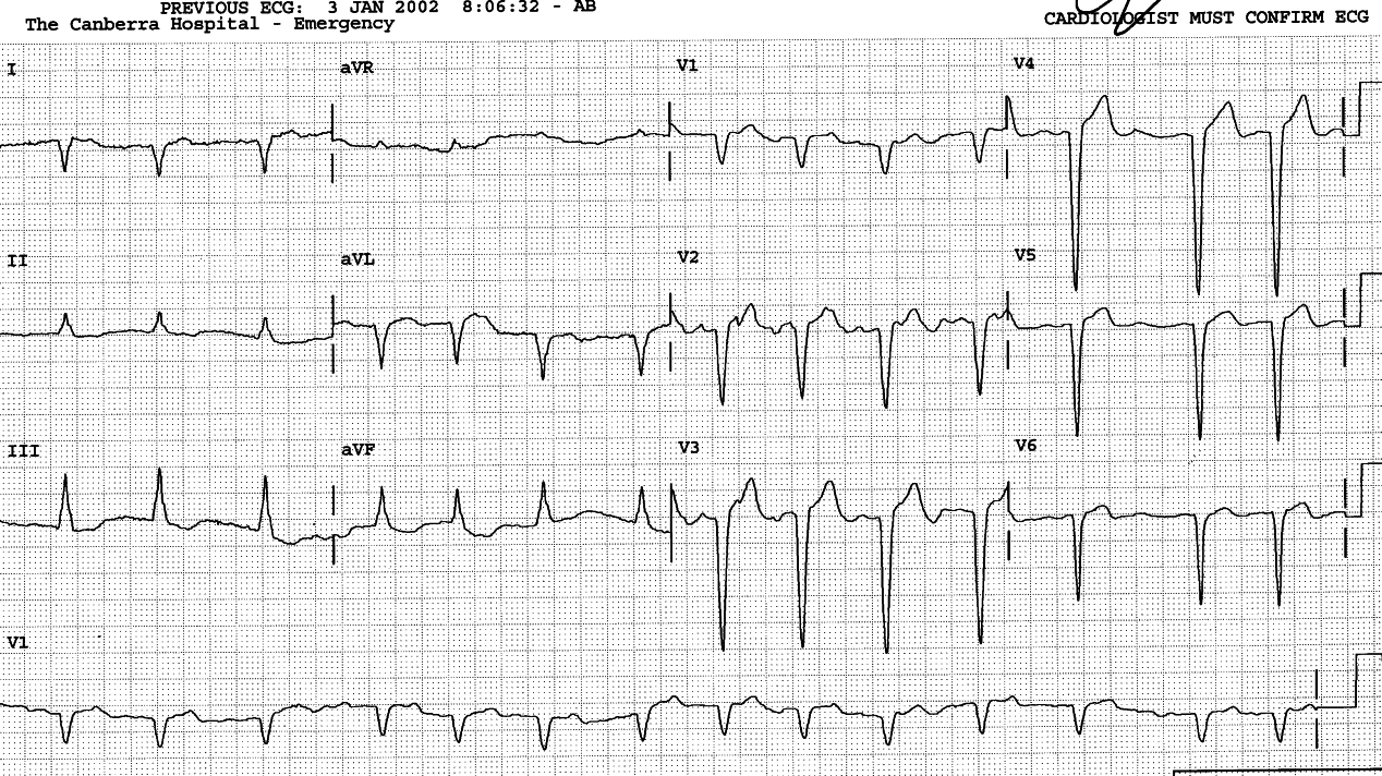 Different patient, a 73 year old lady with chronic AF, cardiomegaly and LV failure, but no angina. LBBB with RAD is rare, but typical of congestive cardiomyopathy. Lead V6 is probably misplaced.