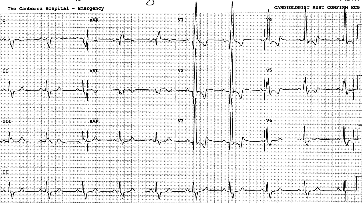 29 year old lady with congenital pulmonary stenosis. She had corrective surgery several years previously.