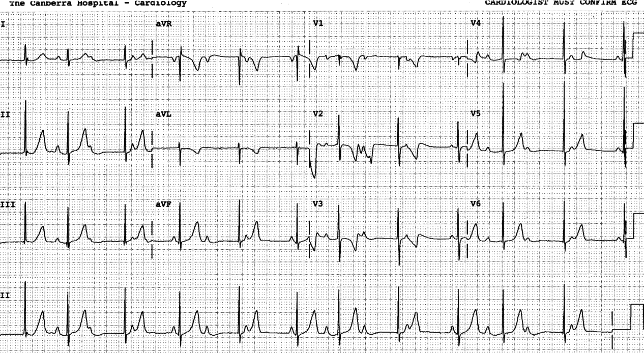 One year old infant with a febrile convulsion in     Casualty. 