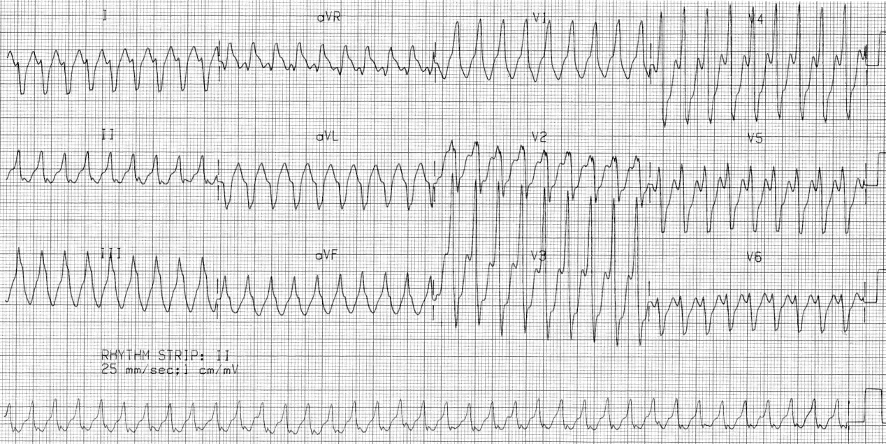 30 year old man treated with verapamil 10mn IV in Casualty for, of all things, âSVT with aberration or VT with underlying WPWâ. 