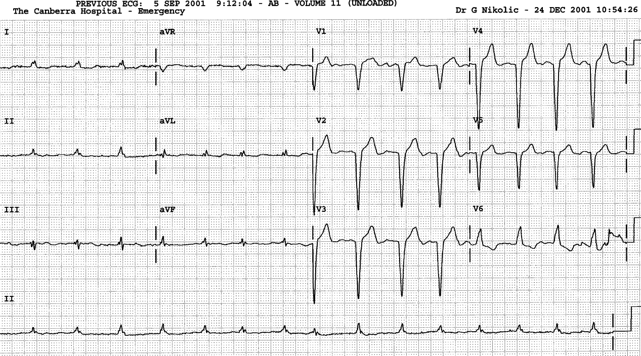 Same patient 6 months earlier, with normal axis.