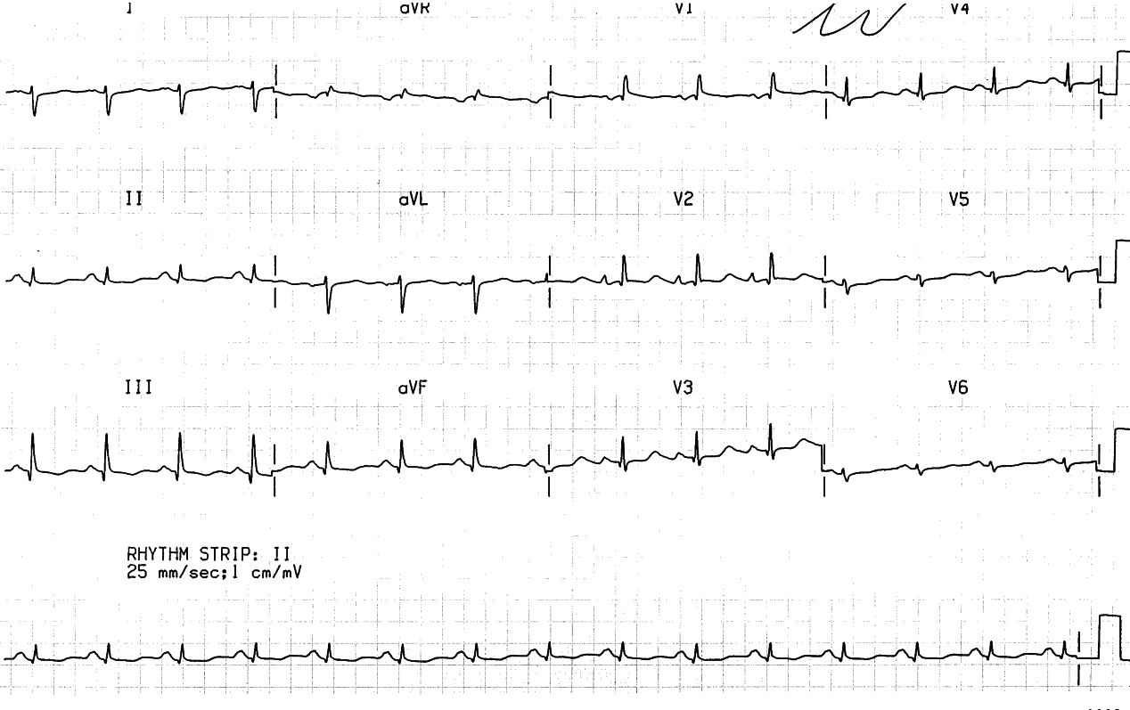 Typical RVH of primary pulmonary hypertension.