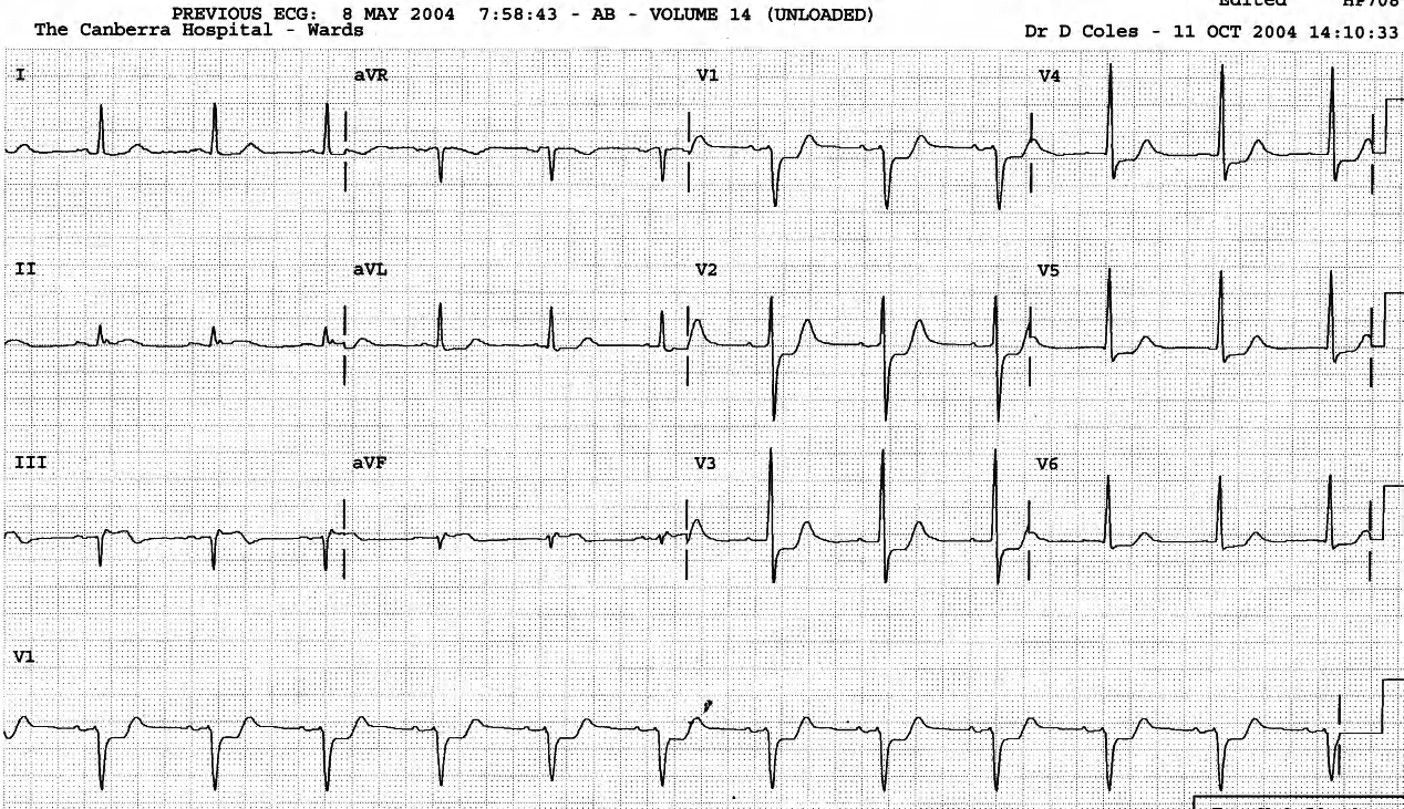 Acute inferior MI. 