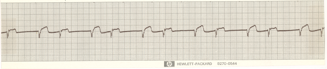 70 year old man with ischÃ¦mic COCM, dying from gas gangrene of the abdominal wall following a cholecystectomy. The bigeminy shown was recorded one hour before death. 