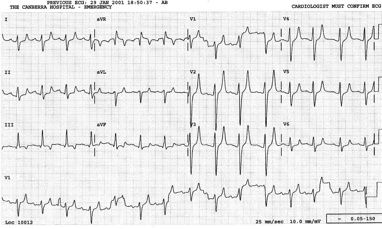 47 year old man on chronic hÃ¦modialysis programme following bilateral nephrectomy for carcinoma