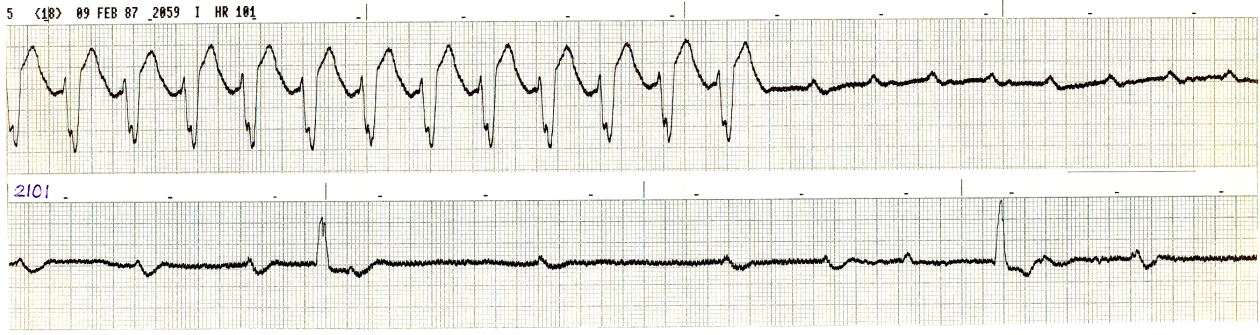 V1 strip in 85 year old man in cardiogenic shock,     nearing the end of his admission. He presented with new LBBB. No attempt     was made to pace him. 