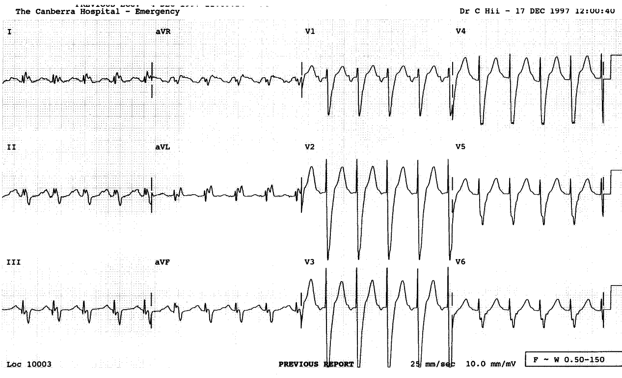 73 year old lady in congestive heart failure.