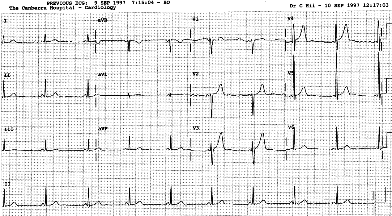 Normalised ECG.