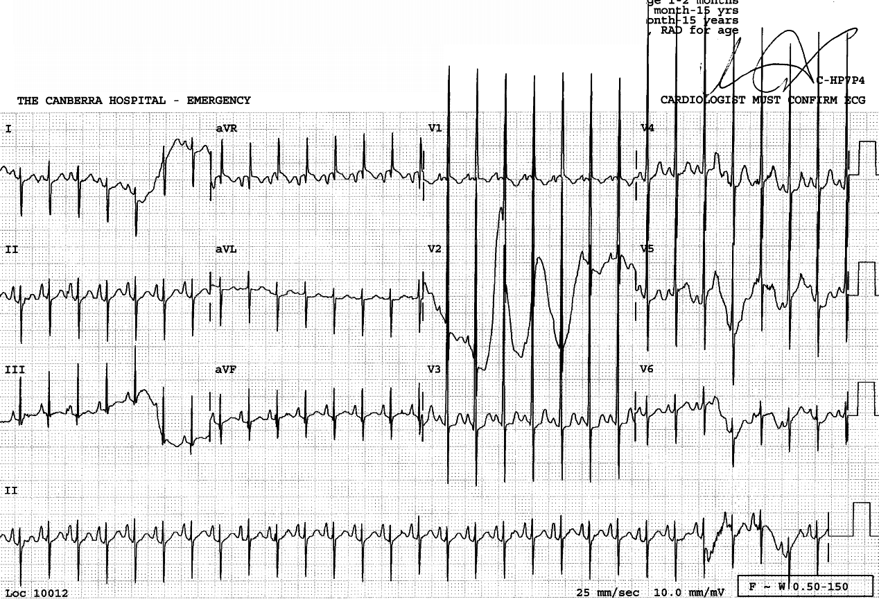 Two months old with congenital heart disease