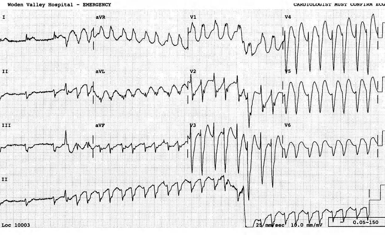 77 year old man on digoxin and hydrochlorothiazide for hypertensive heart disease and atrial fibrillation, in Casualty with severe chest pain. 