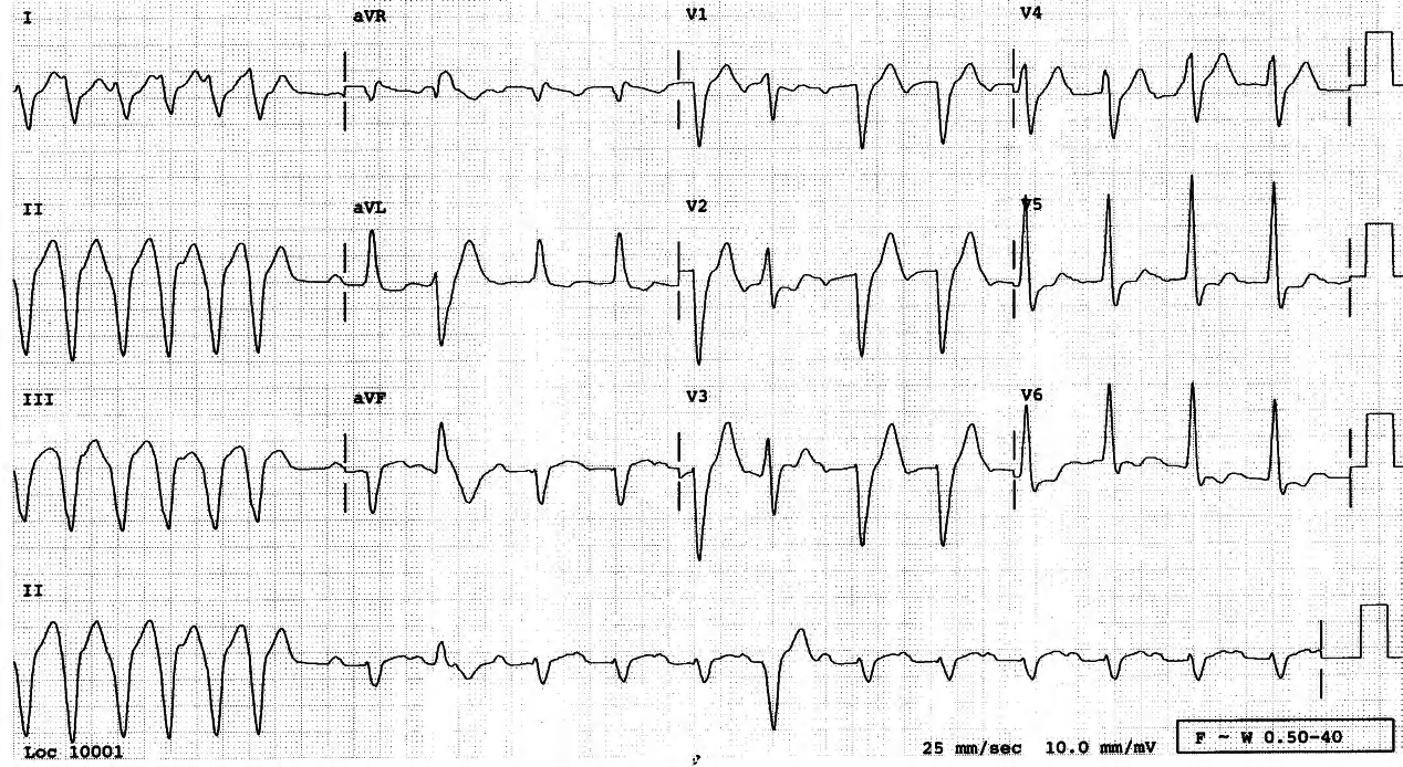 60 year old man with stable angina pectoris and heart failure controlled by digoxin and diuretics. 