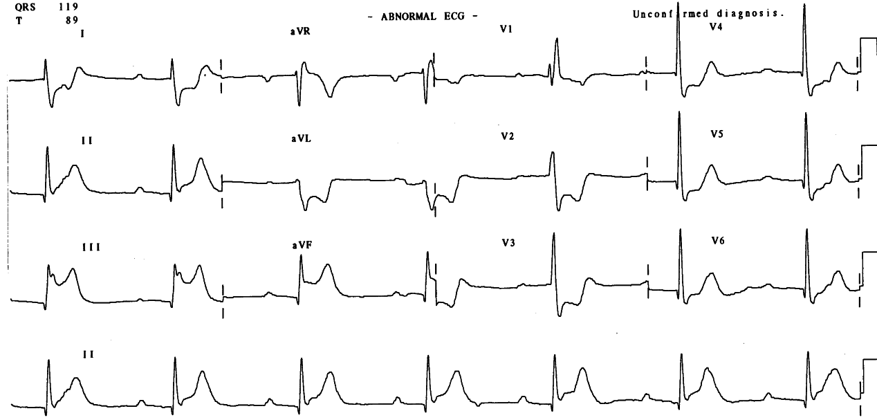 Sinus rhythm, but not sinus bradycardia 39/min. Why?