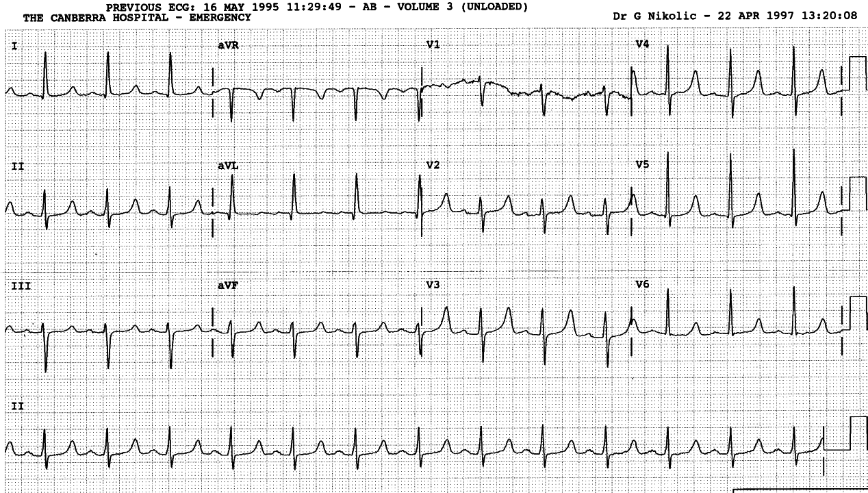 74 year old lady in chronic renal failure