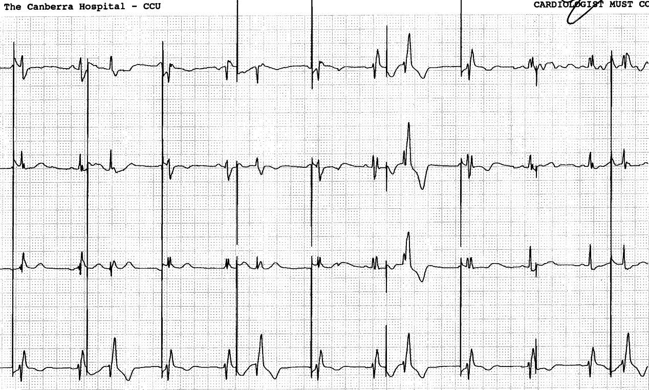 30 year old lady with permanent pacemaker in CCU.
Why?