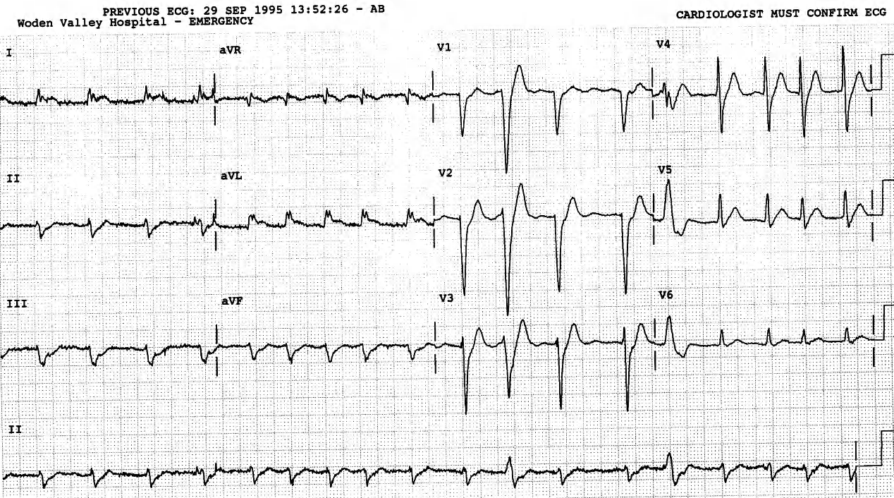 AF, with two LBBB or LBBB-like beats. 