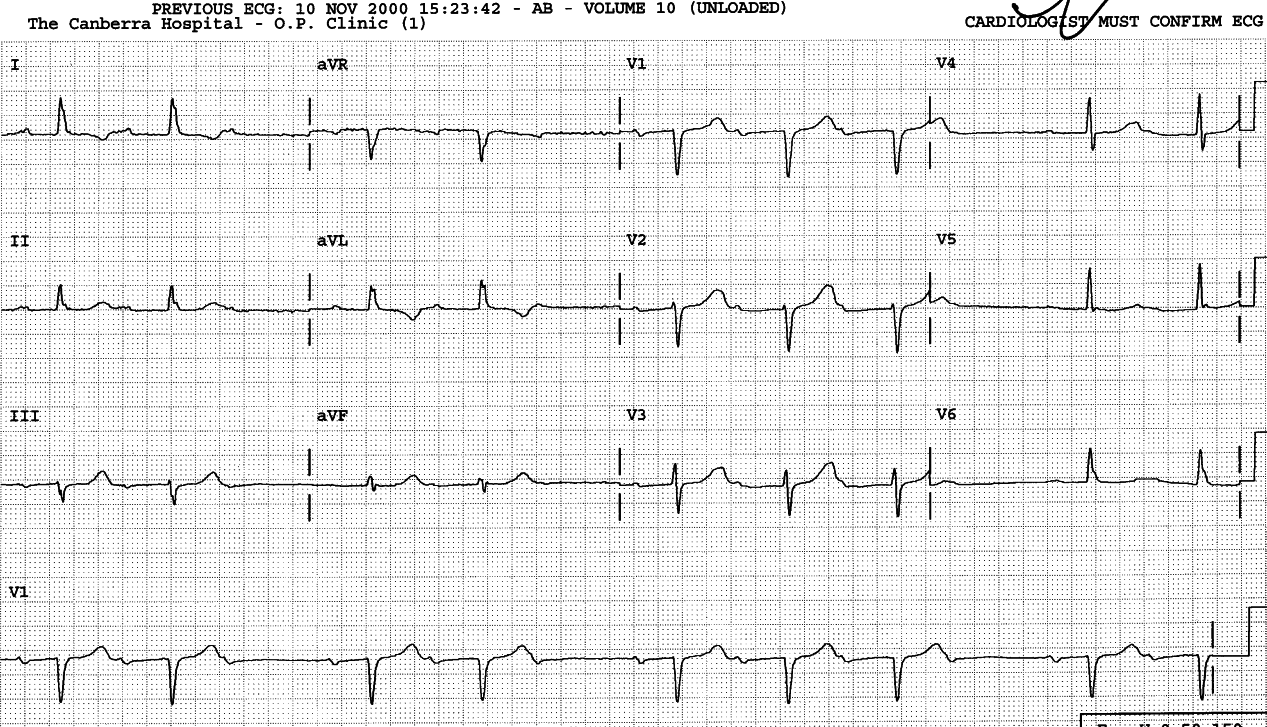 In 7 years, 1o AVB has progressed to 2o, but the QRS complex, minimally widened, remains within normal range.