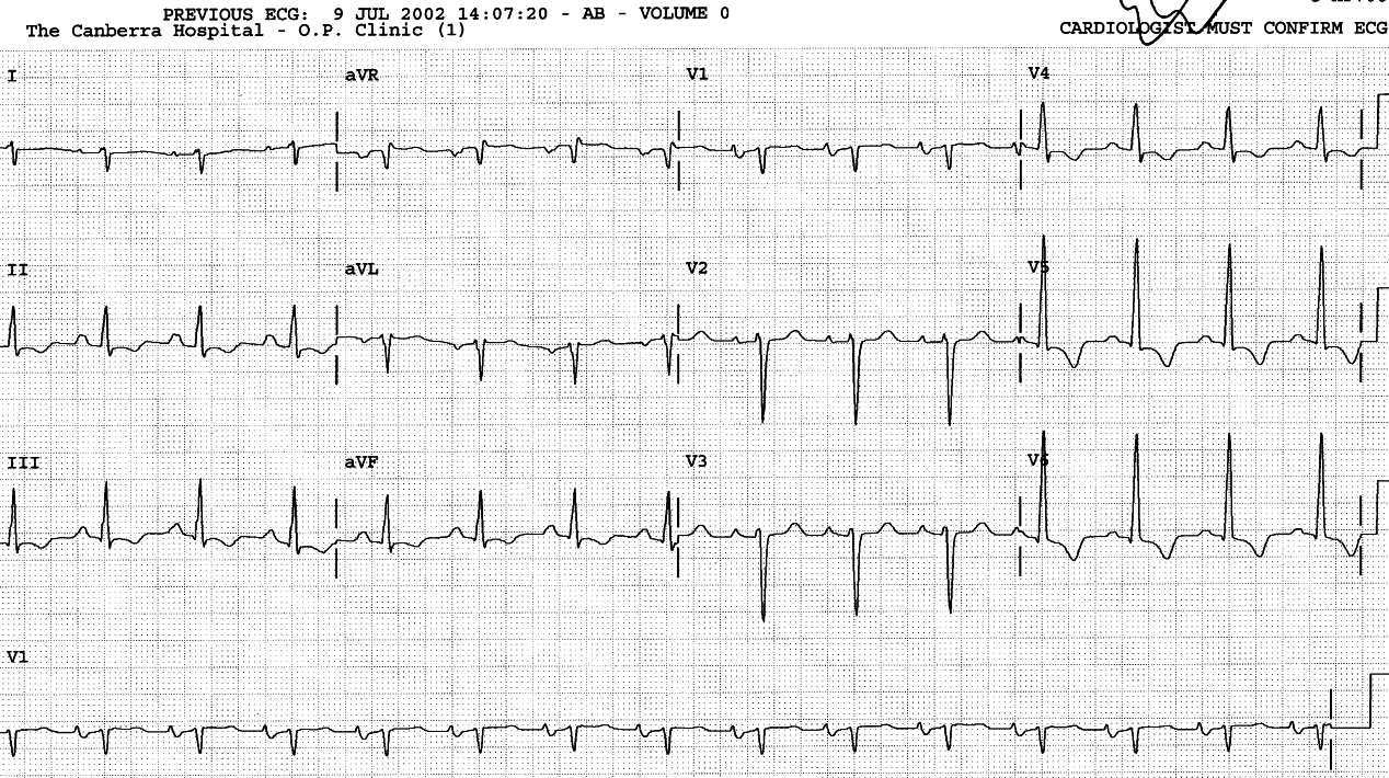 Second transplanted heartâs ECG in a 43 year old lady with tendency to cardiomyopathy