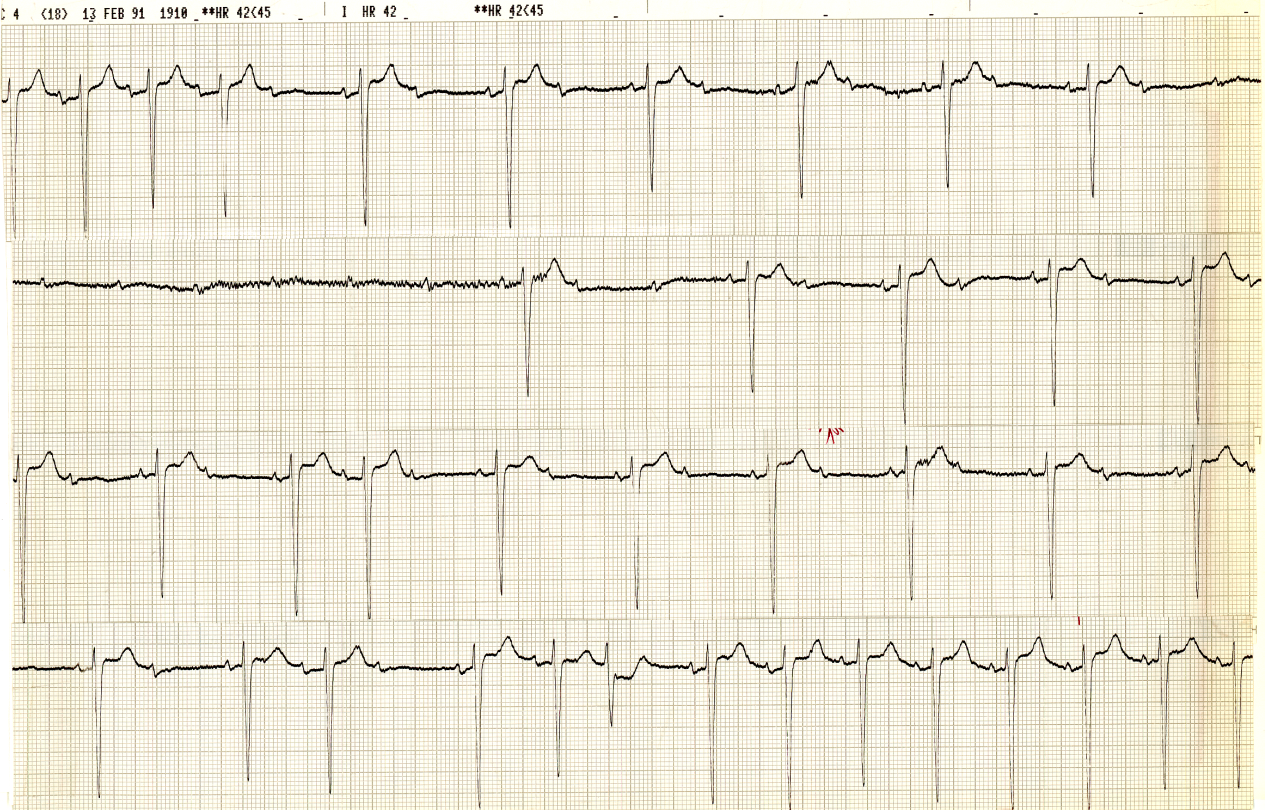 77 year old man on Day 2 of myocardial infarction, sweating and feeling nauseated with urge to defecate and then becoming faint and bradycardic. The 12-lead ECG showed no changes after this episode.