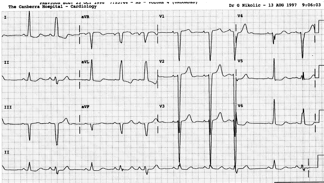 89 year old lady with history of hypertension and strokes.