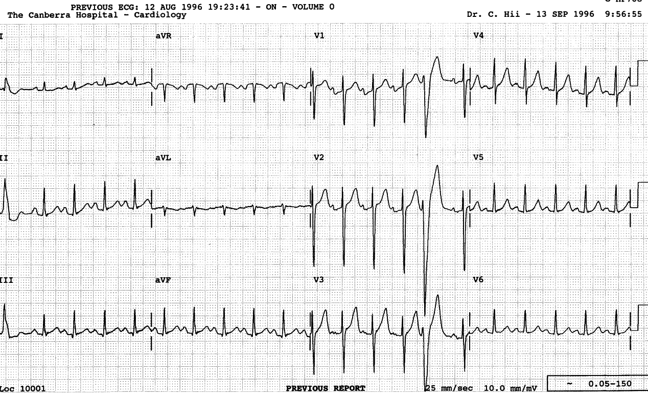 Pre-parathyroidectomy trace. The reasons for tachycardia and VEB is unknown; perhaps (justified) anxiety.