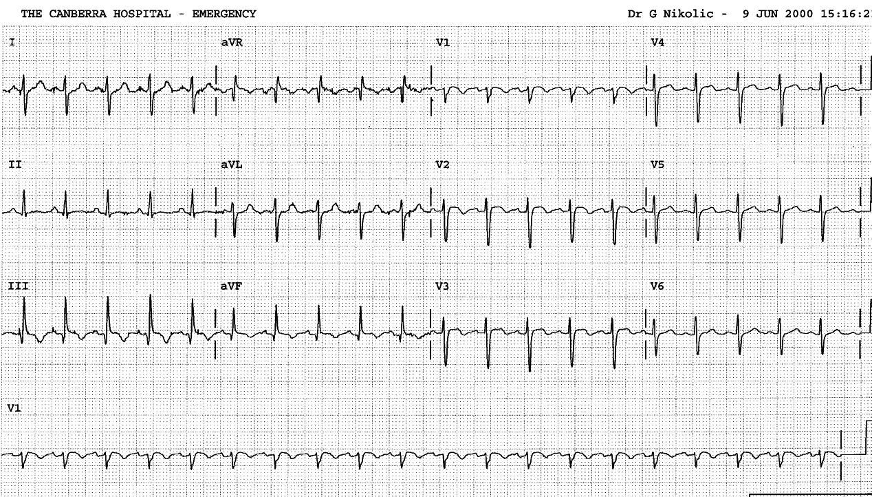 Obese 28 year old lady with Down syndrome, in CCU for unstable blood pressure