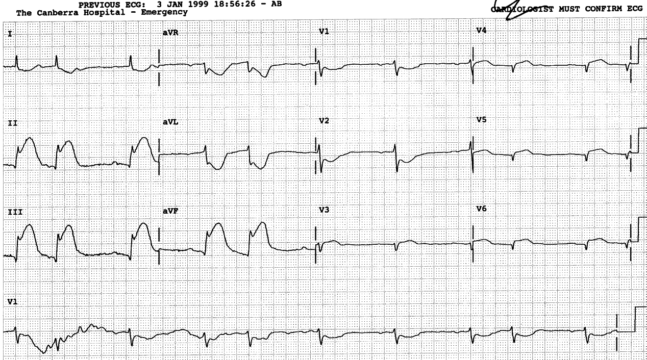 38 year old man with chest pain. Right-sided chest leads are used for this recording. Why?