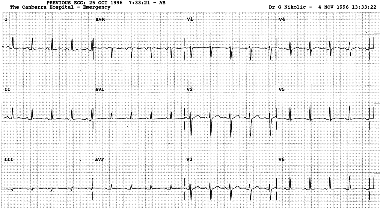 Beginning of âT wave stageâ of pericarditis, 10 days later.