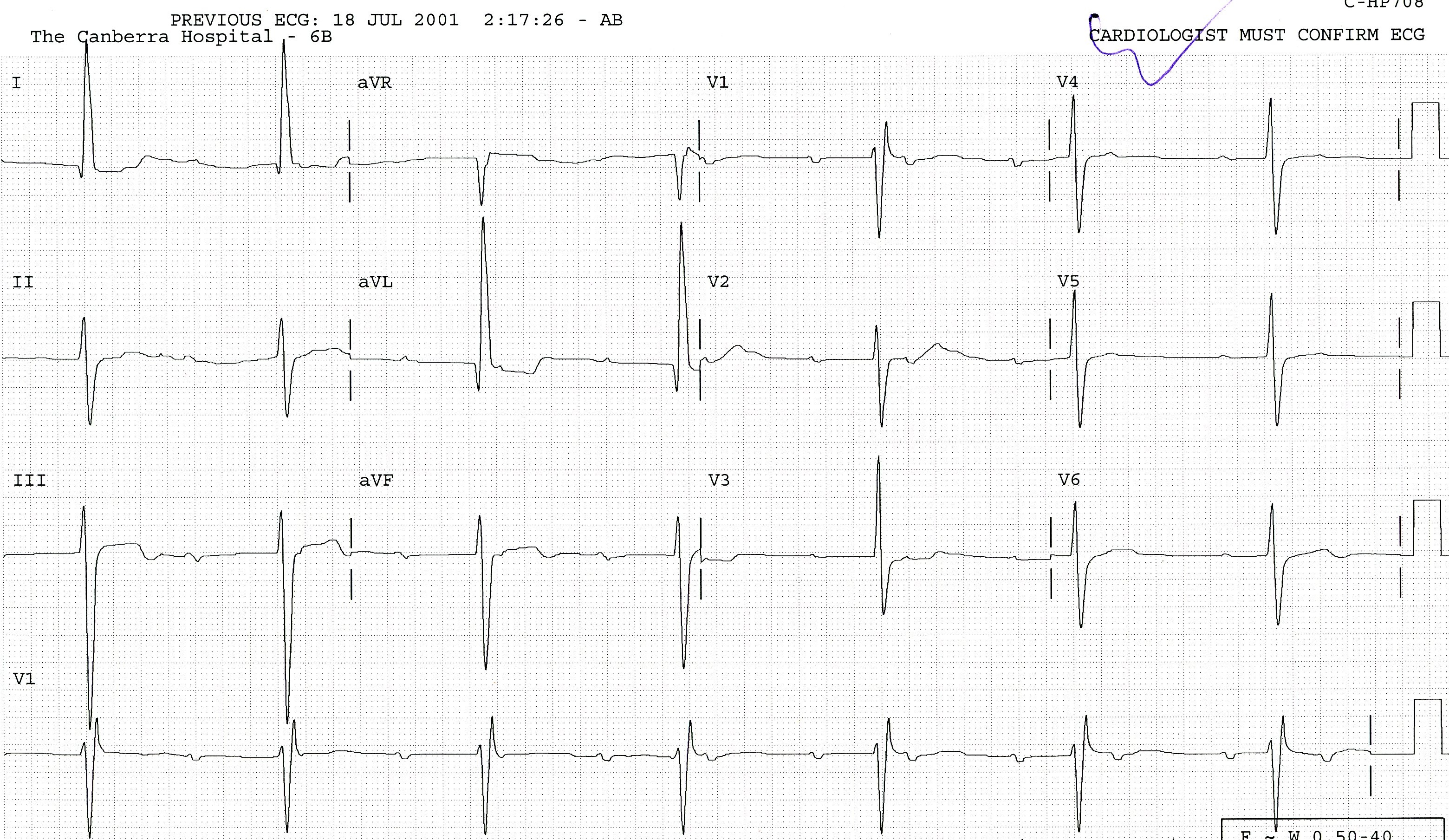 86 year old lady with hypertrophic cardiomyopathy